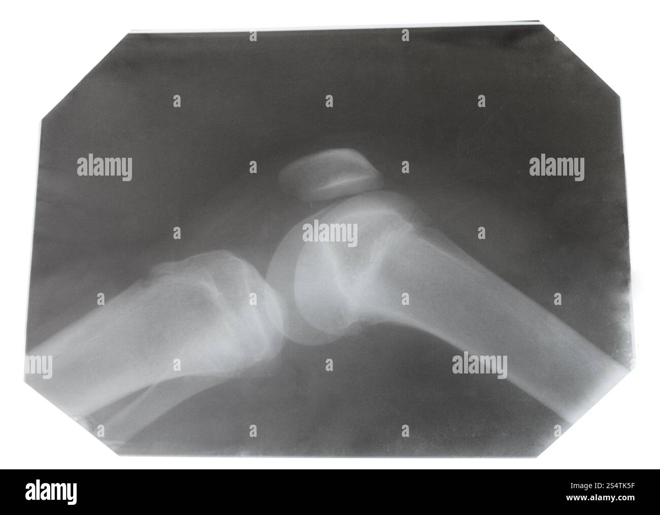 Immagine radiografica dell'articolazione umana del ginocchio isolata su sfondo bianco Foto Stock