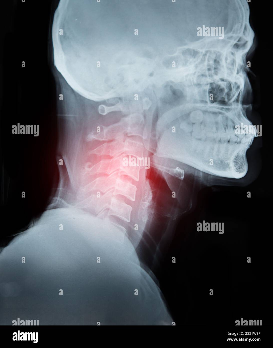 X-ray film immagine particolare del collo e la zona rossa del dolore. Foto Stock