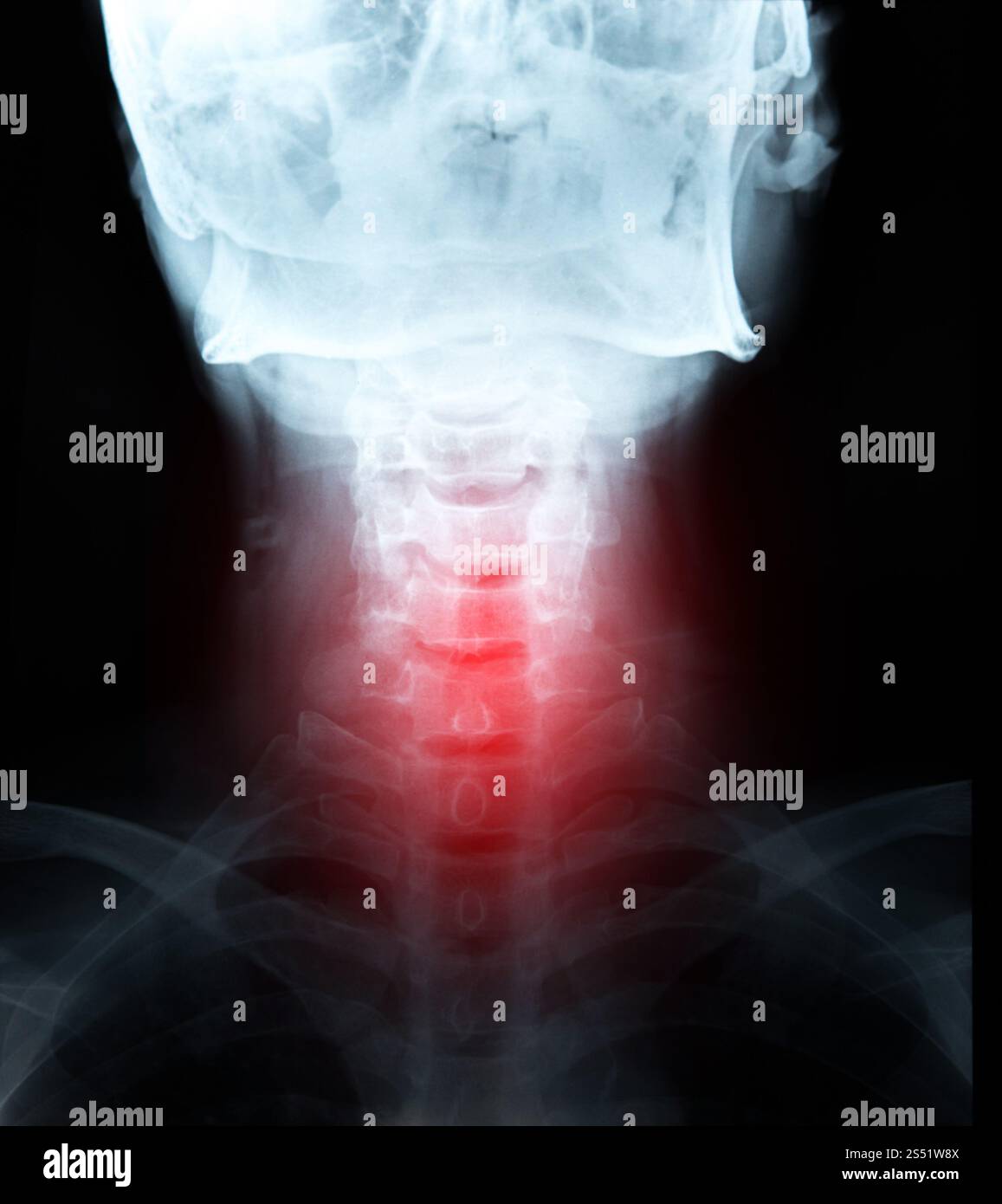 X-ray film immagine particolare del collo e la zona rossa del dolore. Foto Stock
