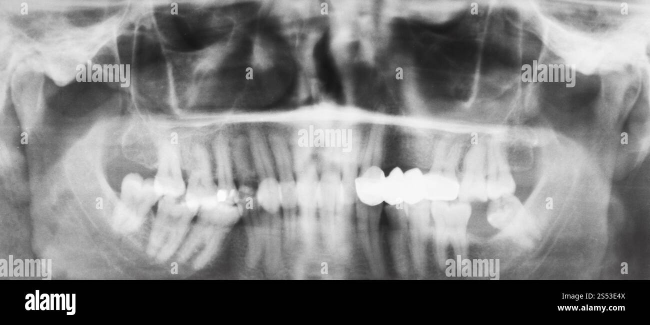 Vista frontale delle ganasce umana con la corona dentale su denti sulla immagine a raggi X Foto Stock