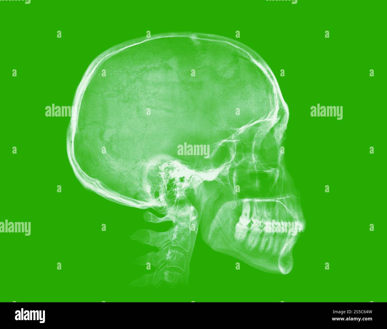 Cranio umano. Immagine radiologica isolata su sfondo verde. Cranio umano. Immagine a raggi X su sfondo verde Foto Stock