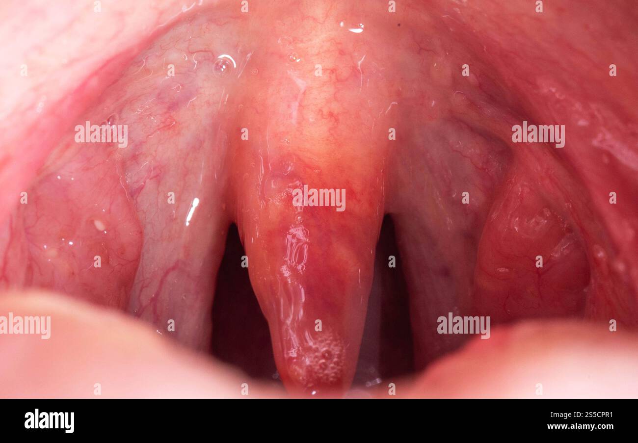 Uvula rossa, infiammata e gonfia in gola. Trattamento dell'uvulite dovuta a batteri e virus streptococcici. Otolaringologia Foto Stock