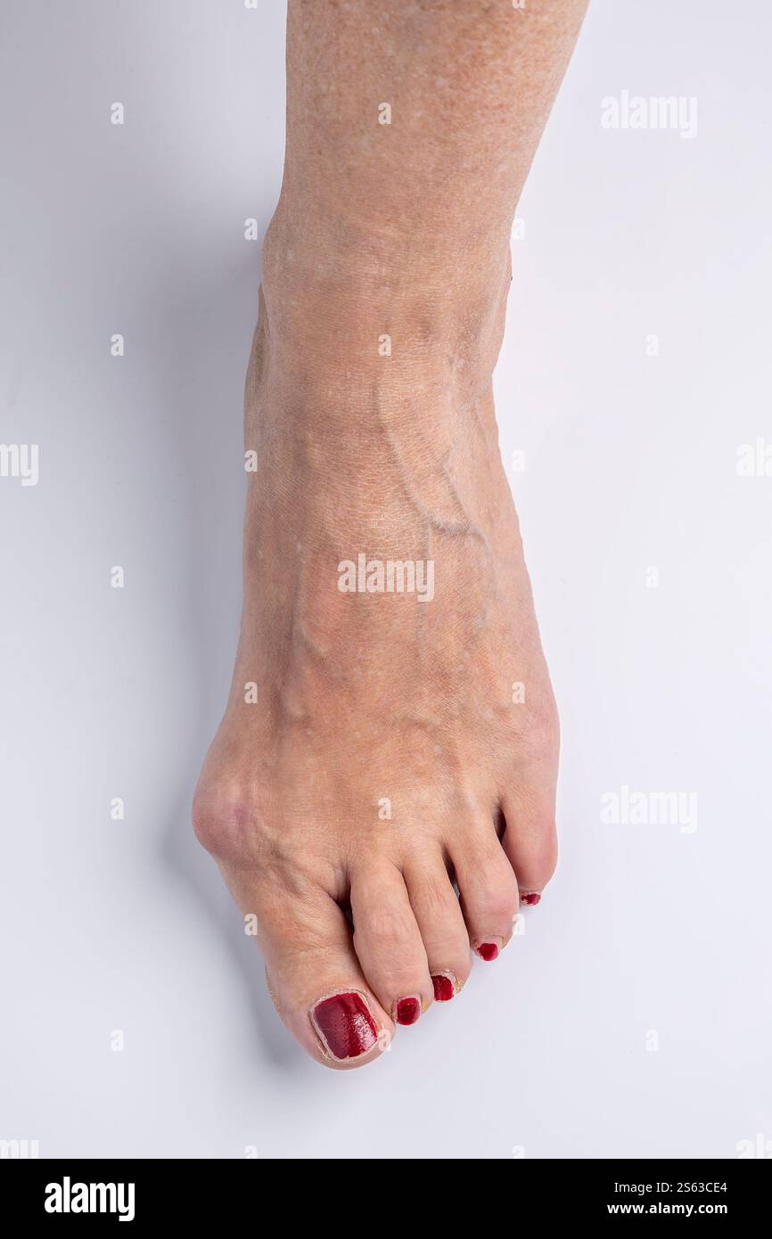 Vista ravvicinata del piede di una donna con un evidente problema di bunion Foto Stock