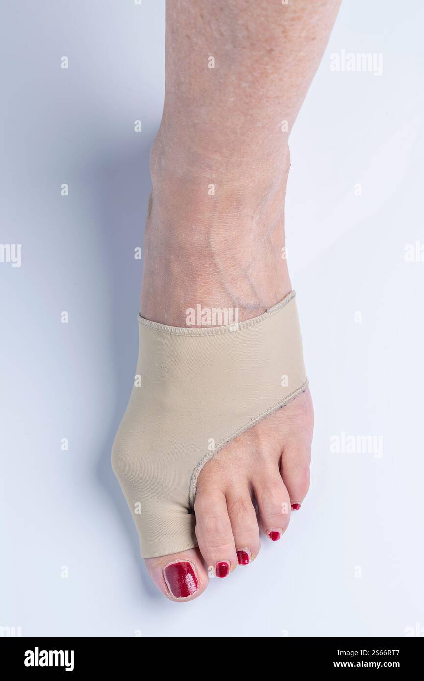 Un piede femminile affetto da allux valgus con un rinforzo in tessuto per correggere la malformazione Foto Stock
