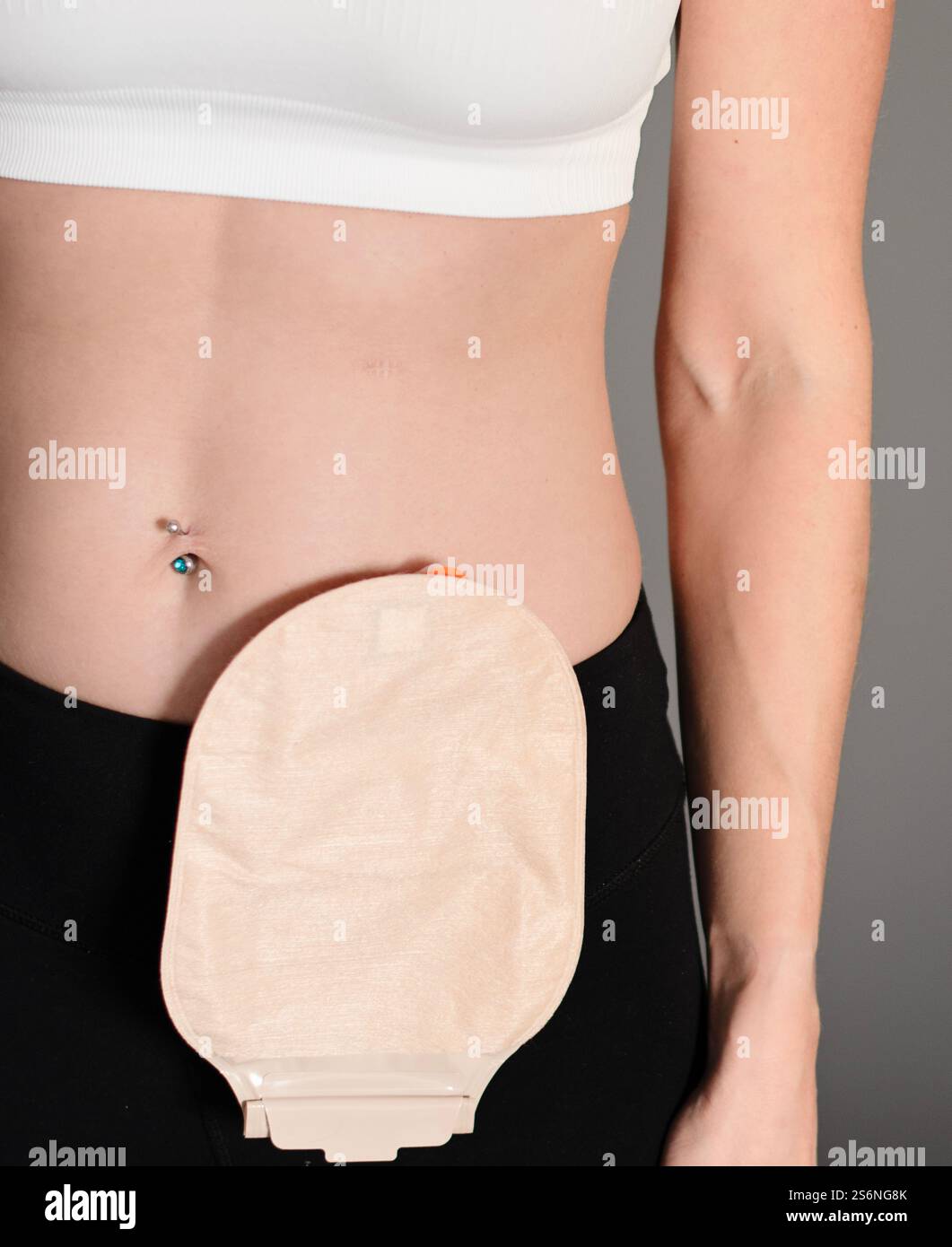 Vista frontale sulla custodia per colostomia attaccata alla paziente donna, tema medico. Sacchetto per ostomia del colore della pelle. Trattamento chirurgico per il cancro del colon. Astuccio per stoma. Foto Stock