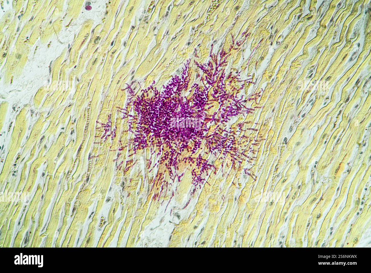 Candida nel muscolo del cuore di un paziente di AIDS, 200x Foto Stock