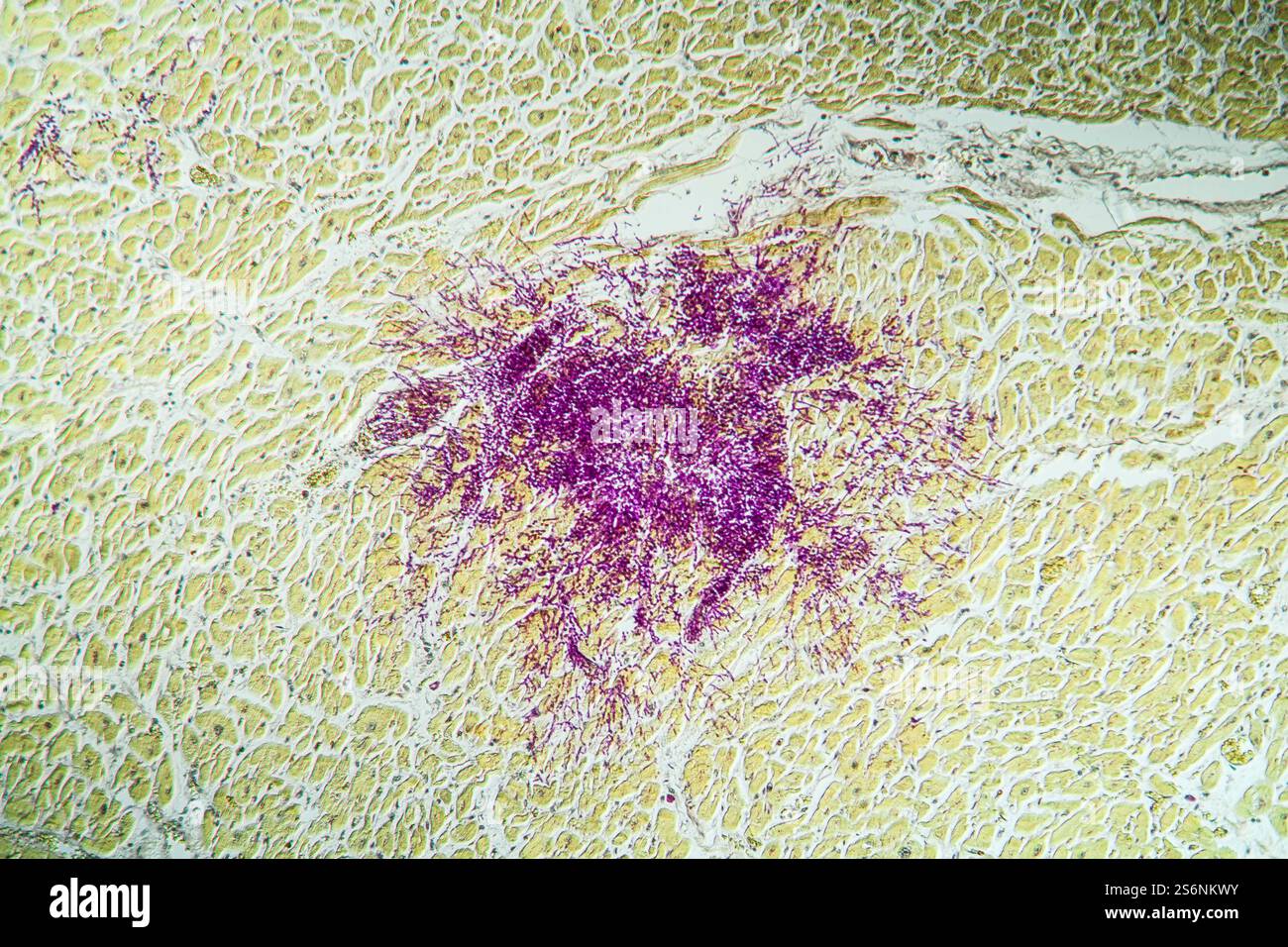 Candida nel muscolo del cuore di un paziente di AIDS, 100x Foto Stock