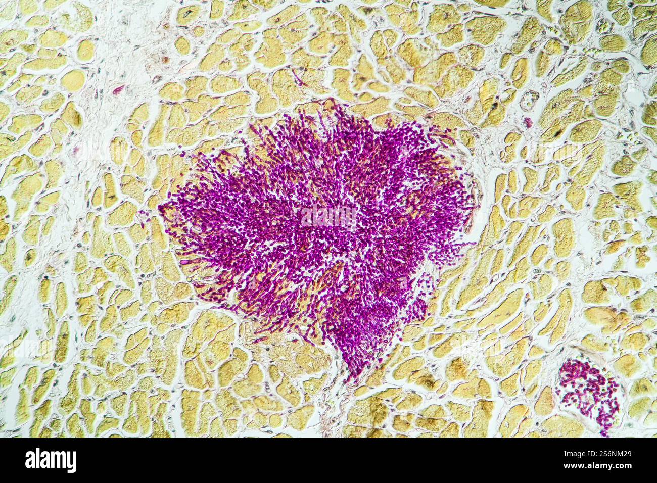 Candida nel muscolo del cuore di un paziente di AIDS, 200x Foto Stock