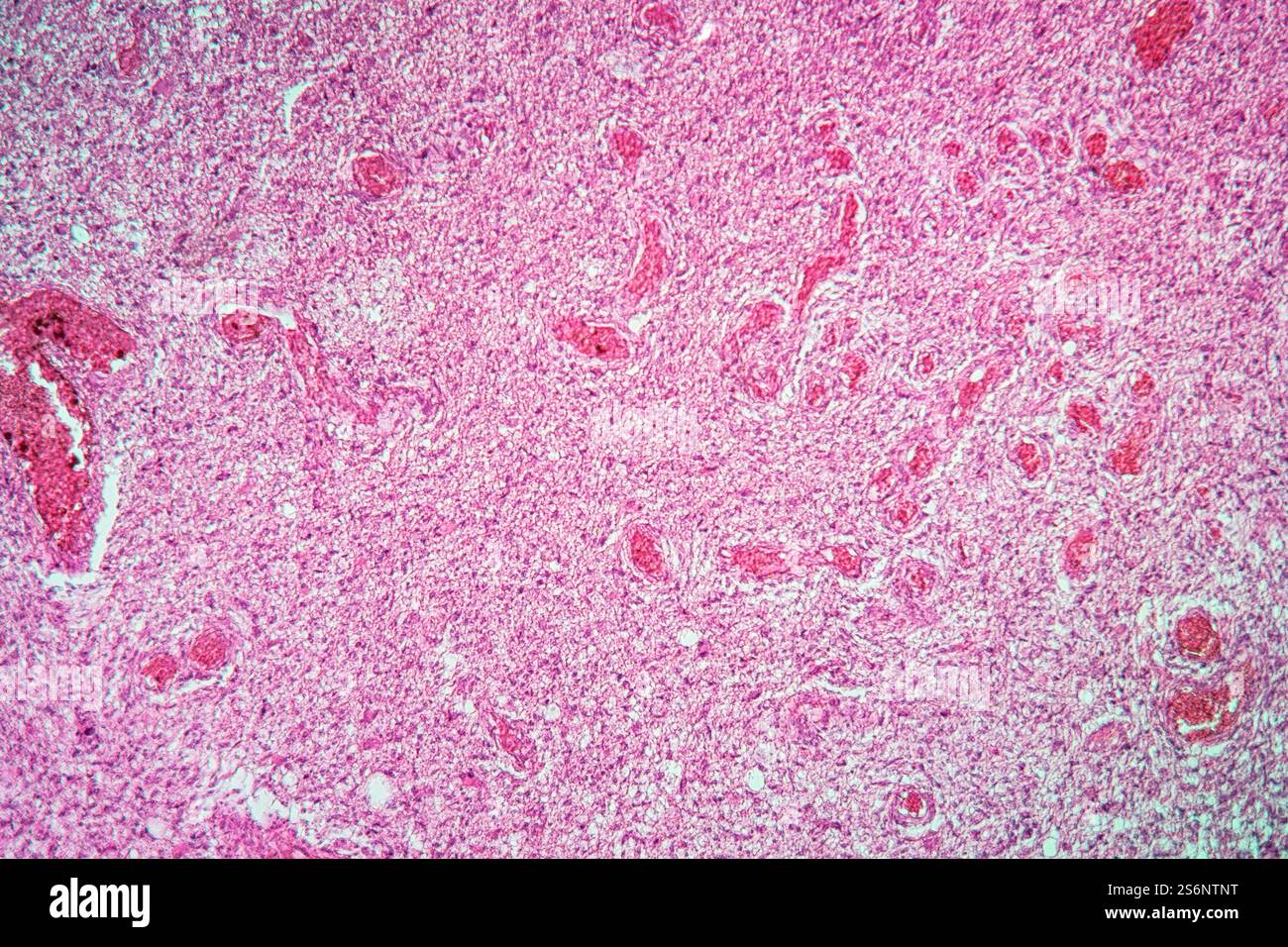Tessuto cerebrale malato 100x Foto Stock