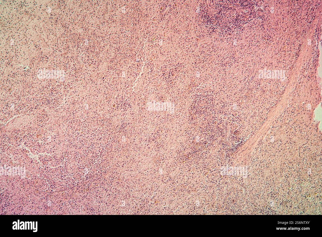Cicatrici nel muscolo cardiaco 100x Foto Stock