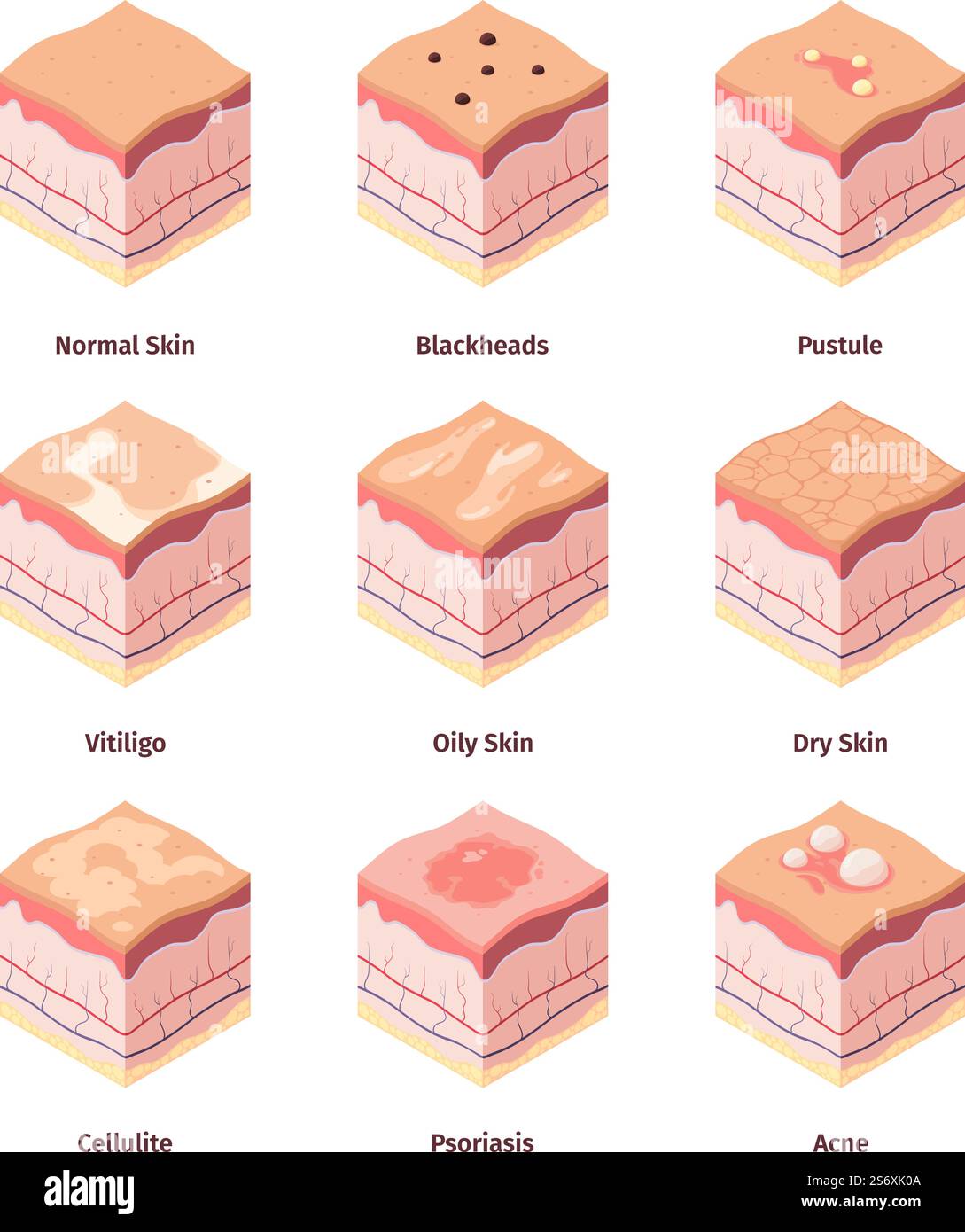 Tipo di pelle. Struttura del derma corpo umano strati incrociati illustrazione biologica dermatologia della cellulite peles immagine isometrica vettoriale arish. Strato di Dermatologia anatomia derma cutanea. Tipo di pelle. Struttura del derma corpo umano strati incrociati illustrazione biologica dermatologia della cellulite peles immagine isometrica vettoriale arish Illustrazione Vettoriale