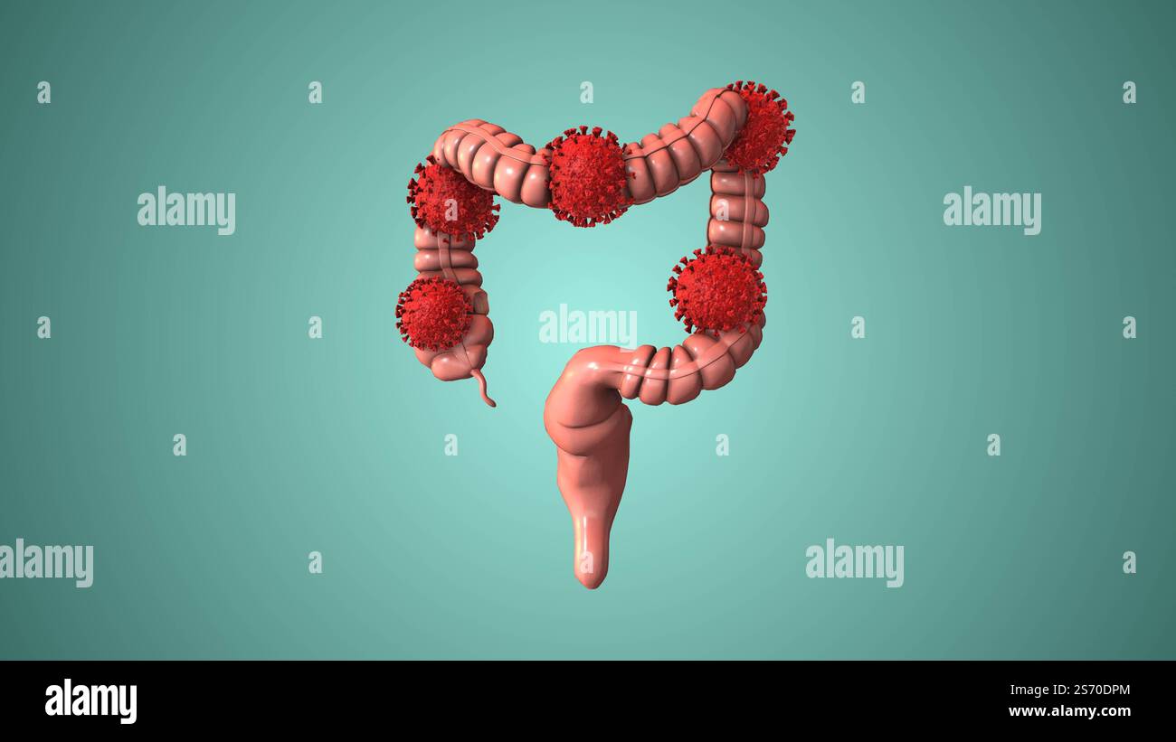 Cellule virali che colpiscono l'intestino crasso Foto Stock