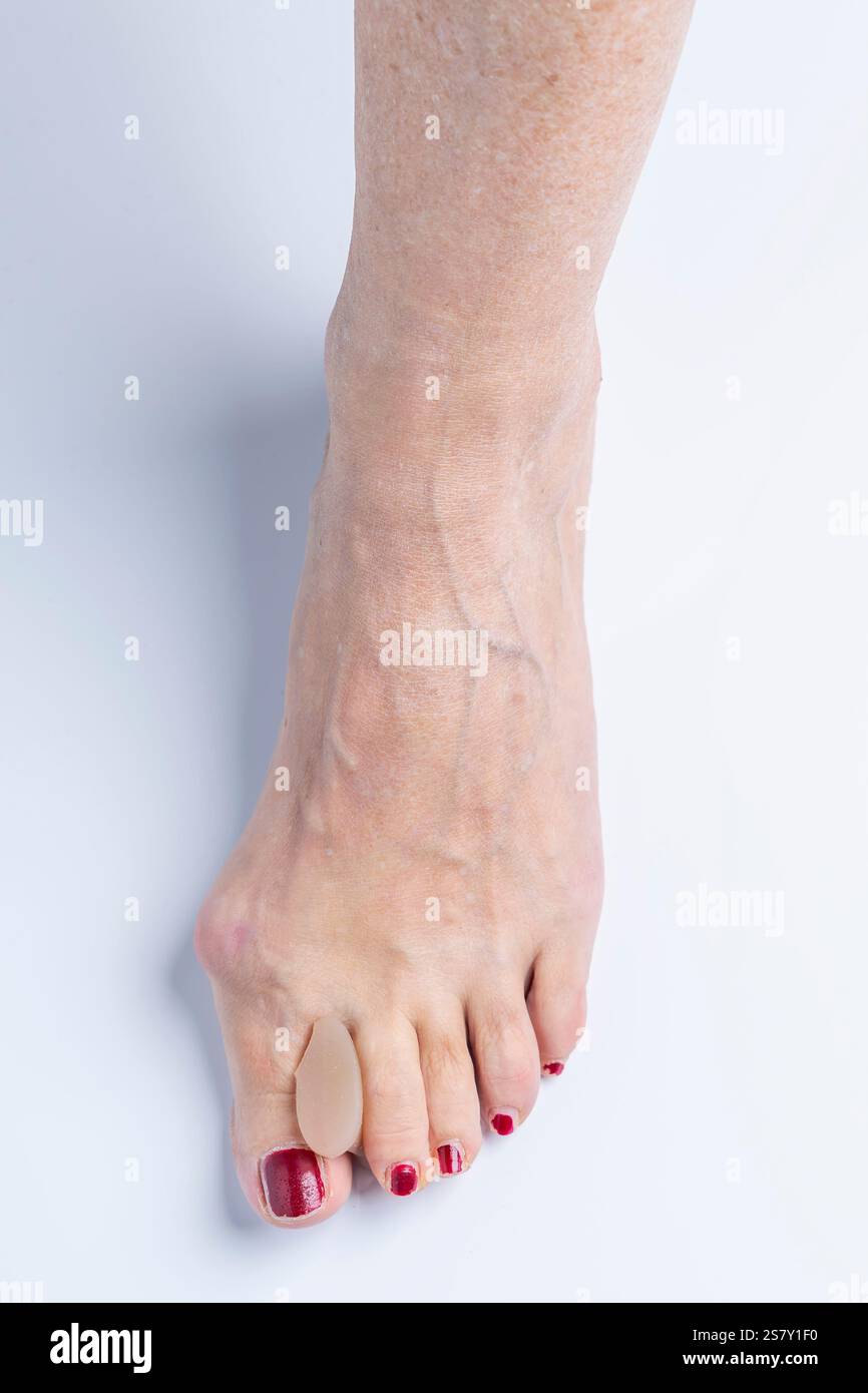 Un separatore di silicone inserito tra l'alluce e la punta indice di un piede con allux valgus Foto Stock