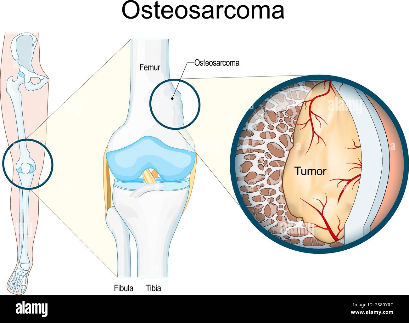Osteosarcoma. Tumore maligno dell'osso. Gamba umana con cancro osseo. Primo piano di un'articolazione del ginocchio e di un tessuto osseo con tumore. Illustrazione vettoriale. Posto medico Illustrazione Vettoriale
