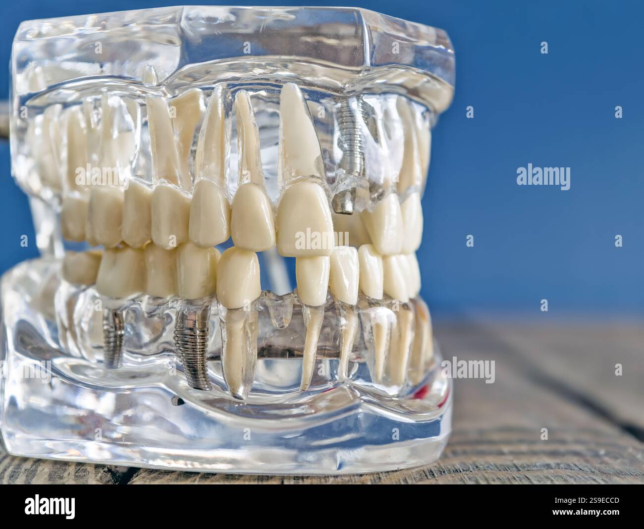 Vista laterale completa di un modello di impianto dentale trasparente con denti artificiali Foto Stock