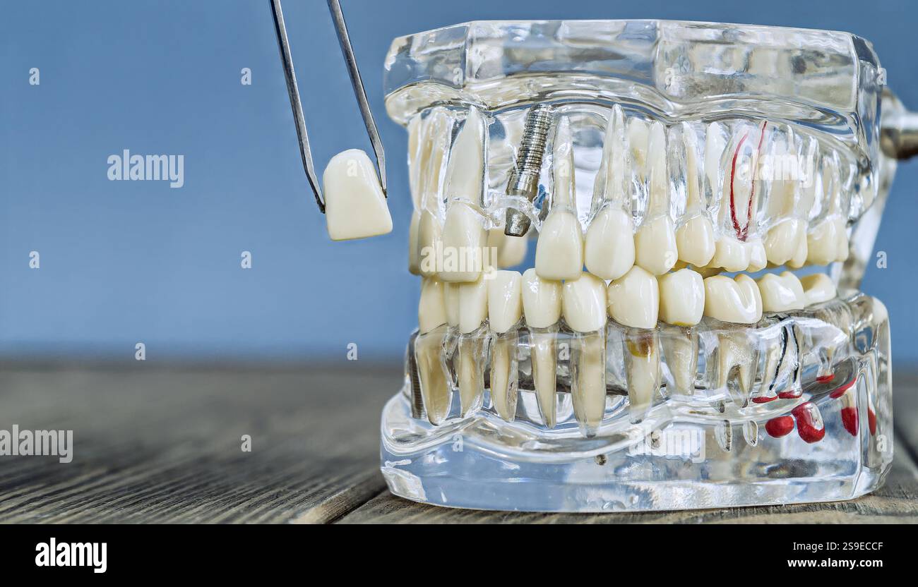 Modello di impianto dentale trasparente dettagliato con pinzette per protesi Foto Stock