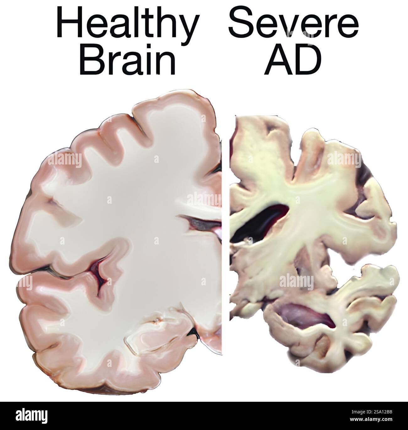 Confronto tra un cervello sano e un cervello con una grave malattia di Alzheimer. Foto Stock