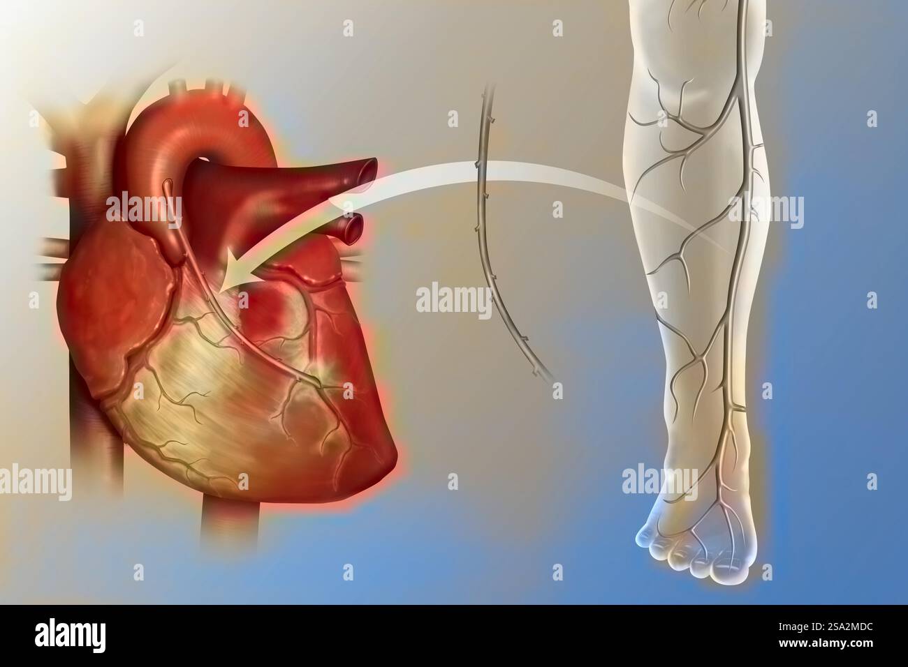 Innesto di bypass arterioso coronarico. Foto Stock