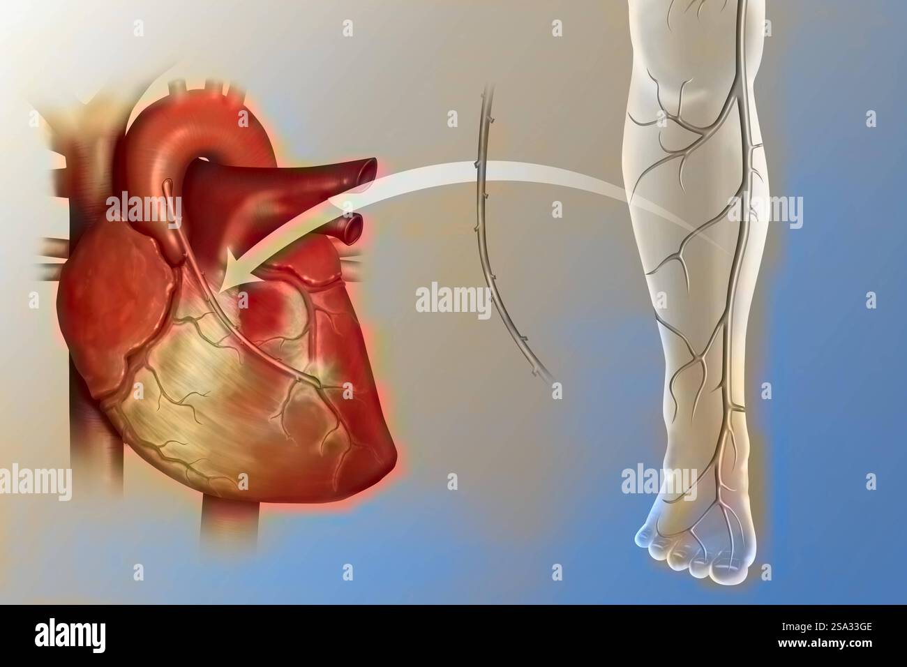 Innesto di bypass coronarico. L'ostruzione di un vaso coronarico in giallo da una placca ateromatosa viene compensata dal posizionamento di un bypass. Foto Stock