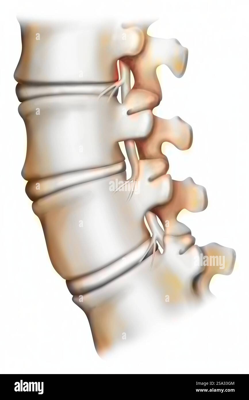 Vertebre lombari sane. Vedere le immagini 1530707 per la spondilartrosi con osteoartrite interafofisaria e compressione del midollo spinale, 1530807 per Simple Foto Stock