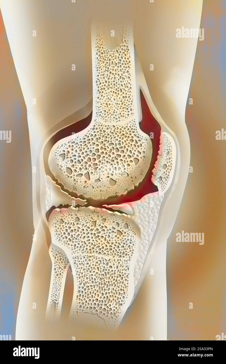 Osteoartrite gonartrosi del ginocchio. L'osteoartrite può influenzare una o più articolazioni del ginocchio. Si tratta di osteoartrite globale con coinvolgimento dell'inte Foto Stock