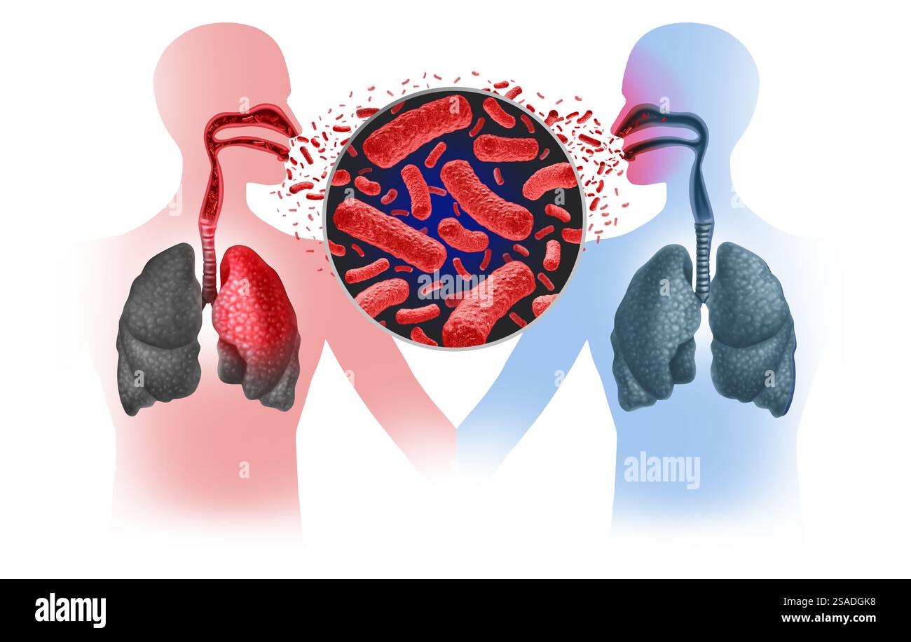 Tubercolosi focolaio e trasmissione TB come infezione batterica contagiosa a causa di batteri Mycobacterium che infettano i polmoni e altre parti del Foto Stock Tubercolosi focolaio e trasmissione TB come infezione batterica contagiosa a causa di batteri Mycobacterium che infettano i polmoni e altre parti del Foto Stock