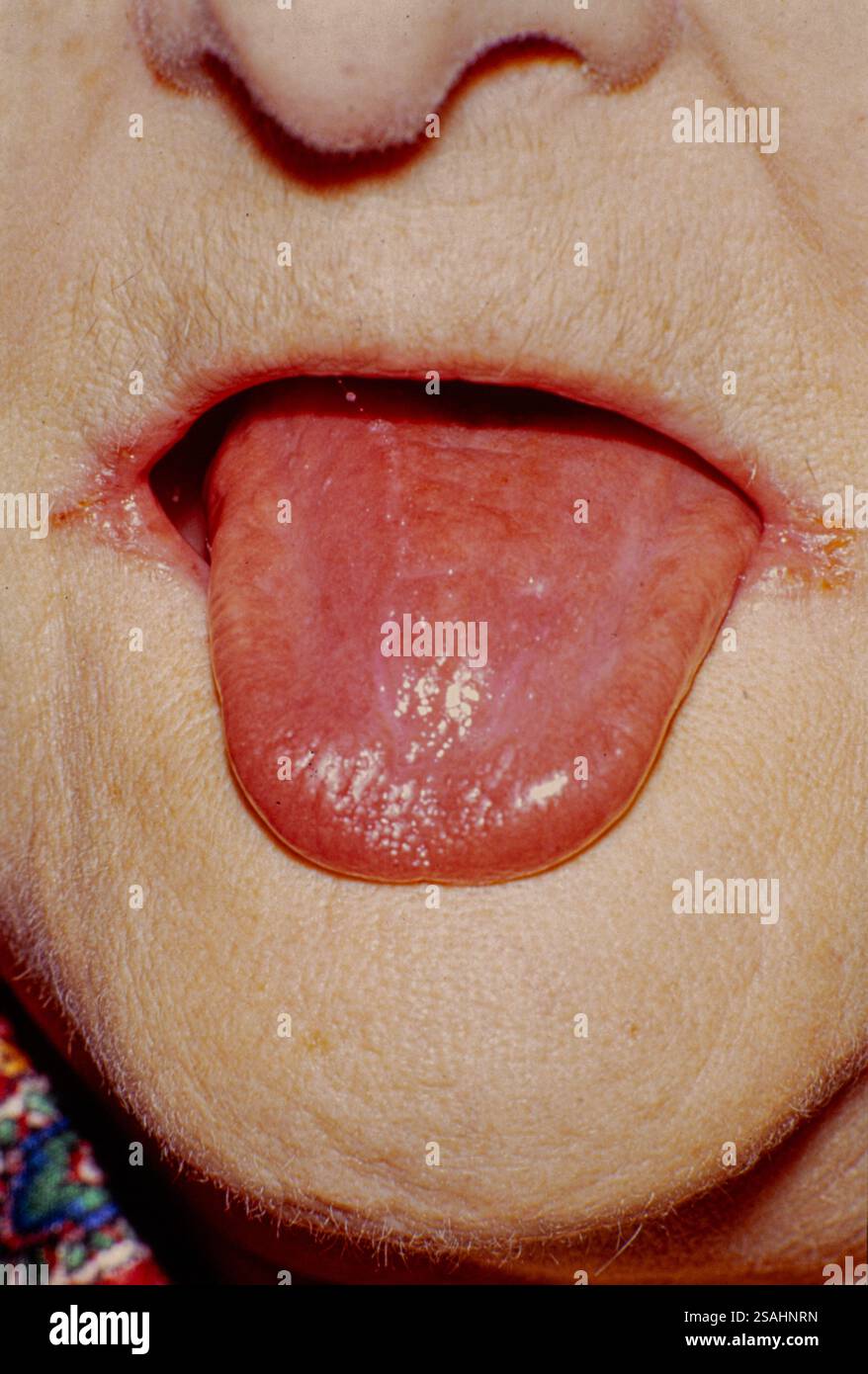Cheilite angolare, una malattia infettiva dell'angolo delle labbra causata da candida albicans. Foto Stock Cheilite angolare, una malattia infettiva dell'angolo delle labbra causata da candida albicans. Foto Stock