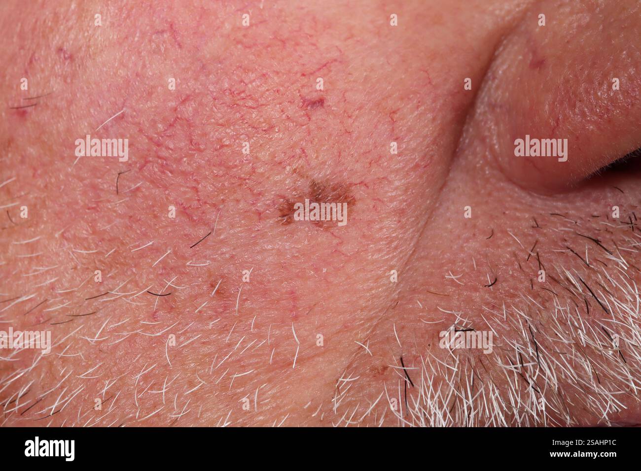 Dubreuilh melanoma della guancia in un uomo di 77 anni. Foto Stock