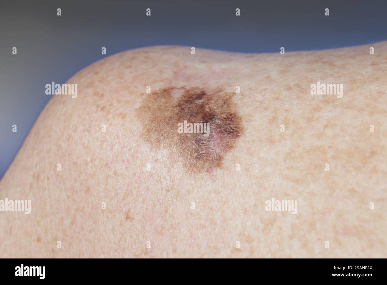 Dubreuilh melanoma della spalla in una donna di 77 anni. Foto Stock