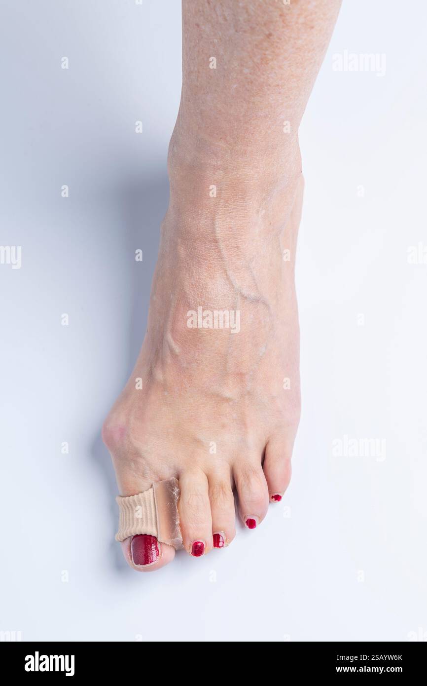 Separatore in silicone con anello elastico, inserito tra l'alluce e l'indice di un piede con allux valgus Foto Stock