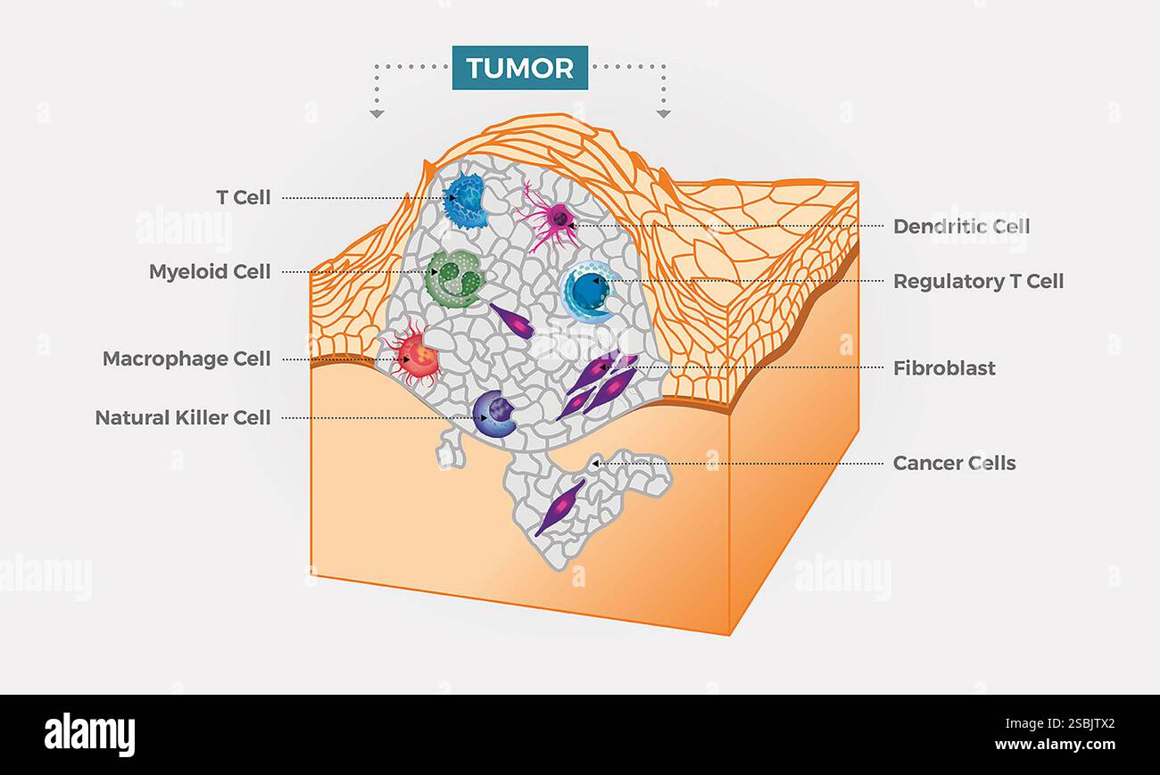 All'interno di un tumore, le cellule tumorali sono circondate da una varietà di cellule immunitarie, fibroblasti, molecole e vasi sanguigni -- ciò che è noto come microambiente tumorale. Le cellule tumorali possono cambiare il microambiente, il che a sua volta può influenzare il modo in cui il cancro cresce e si diffonde. Foto Stock