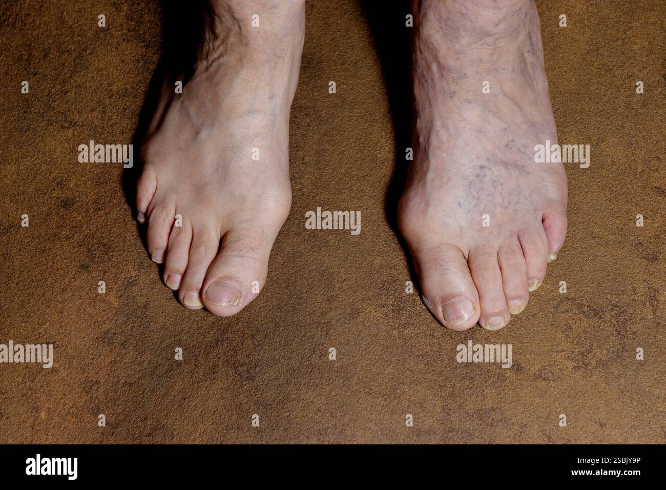 Gambe di un adulto con curvatura visibile dell'alluce. Foto Stock