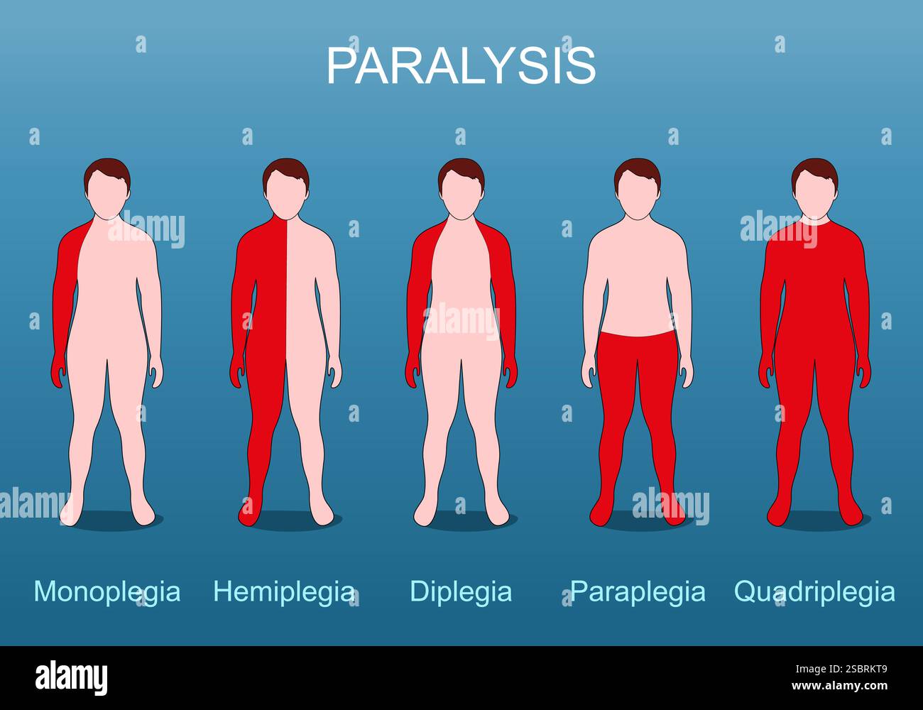 Paralisi, compresa quadriplegia, paraplegia, emiplegia, monoplegia, e diplegia. Atrofia muscolare. Perdita del funzionamento del motore. Danno al sistema nervoso Illustrazione Vettoriale