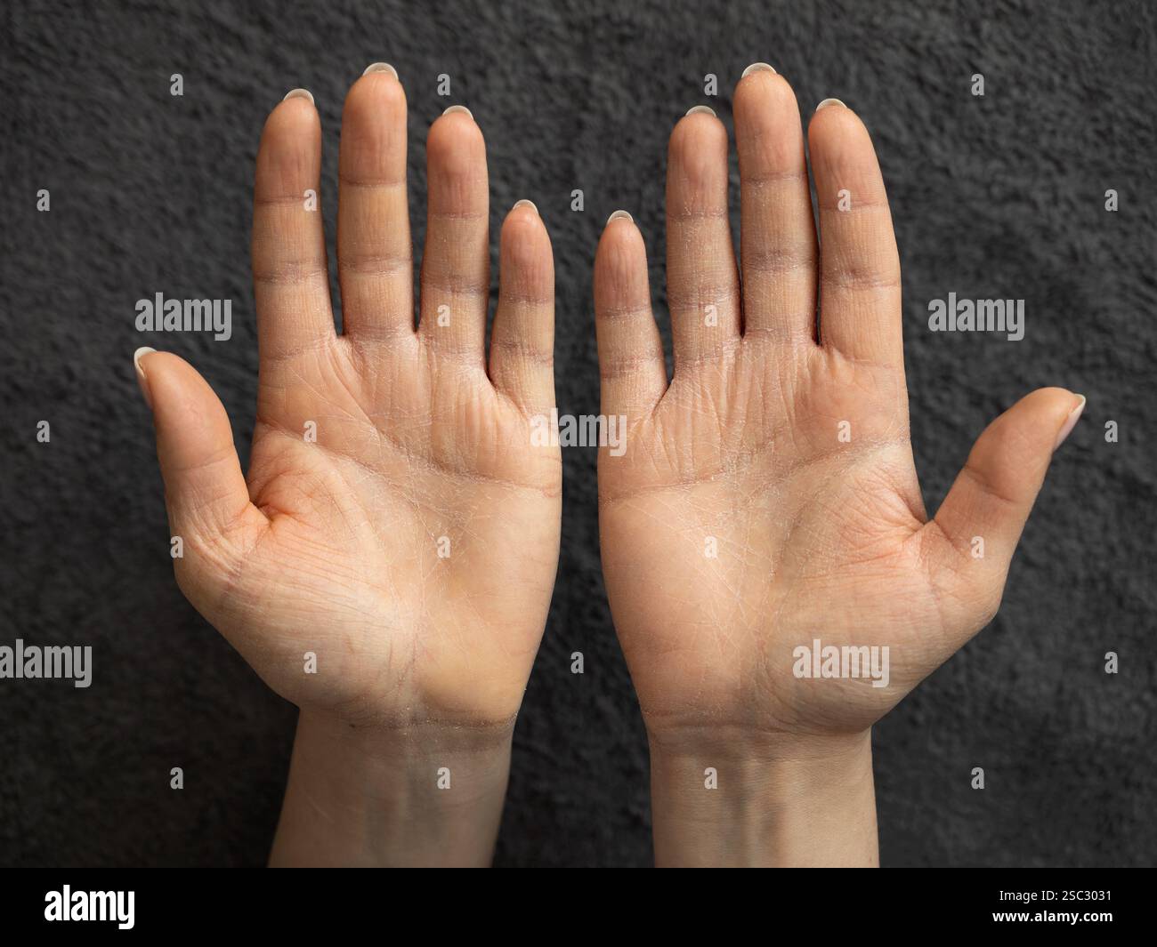 Eczema della mano (dermatite) primo piano. Pelle secca del palmo a causa delle condizioni ambientali. Peeling e crosta della pelle causando prurito e dolore su entrambe le mani. Foto Stock