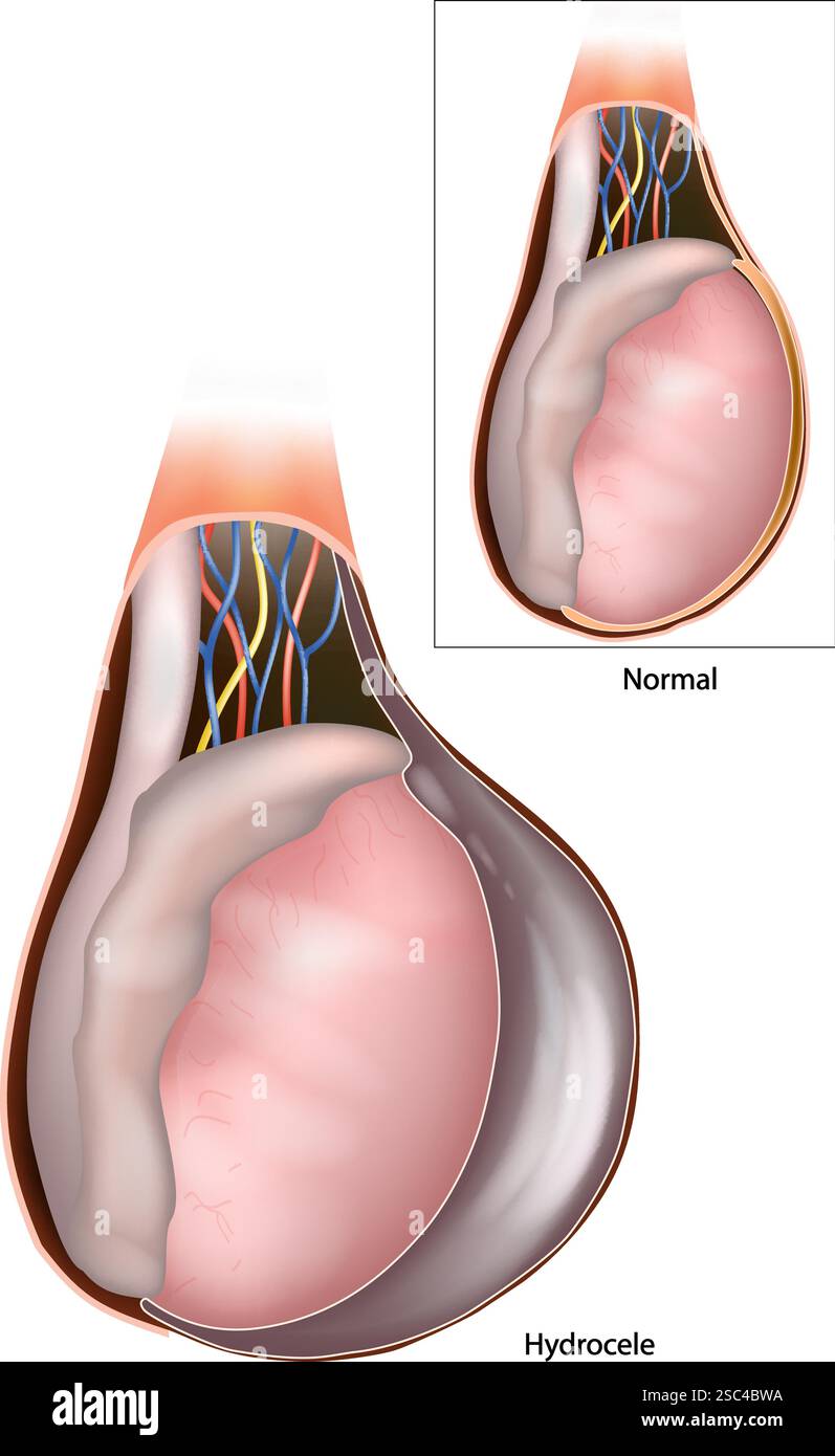 Testicolo idrocele. Accumulo di liquido sieroso in una cavità corporea. Tunica vaginalis. Anatomia testicolare. Sezione trasversale del sistema riproduttivo maschile Illustrazione Vettoriale
