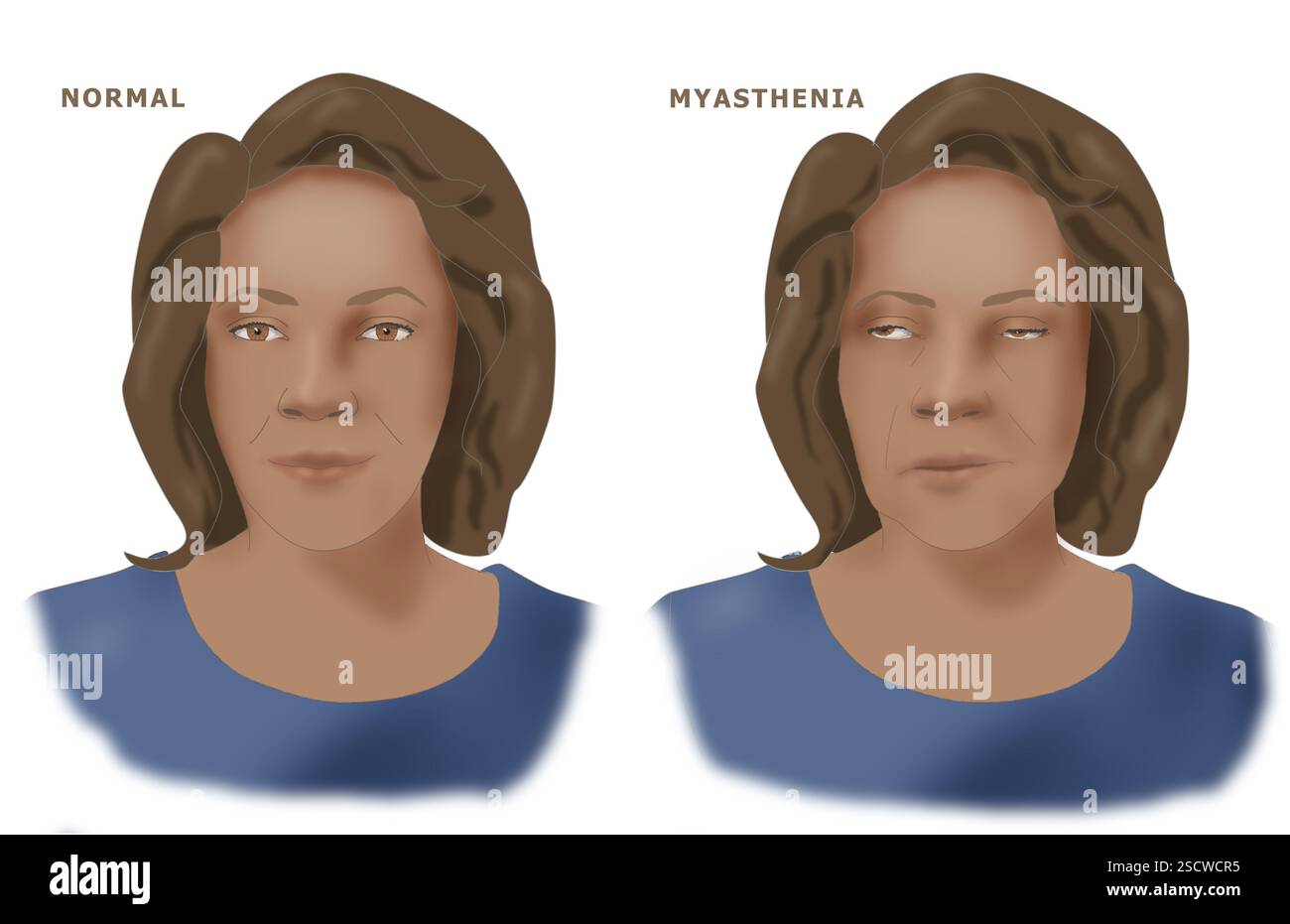 La miastenia grave è una condizione che coinvolge muscoli volontari, più comunemente di occhio, bocca e gola. Illustrazione di una donna nera o ispanica con gli effetti delle tombe della miastenia. Normalmente, l'acetilcolina, un neurotrasmettitore (giallo) rilasciato da un neurone (turchese), viaggia verso i recettori del neurotrasmettitore (verde), portando alla contrazione muscolare. La miastenia grave è una malattia autoimmune in cui ci sono meno recettori del normale. I pochi recettori esistenti sono bloccati da anticorpi (viola). Foto Stock