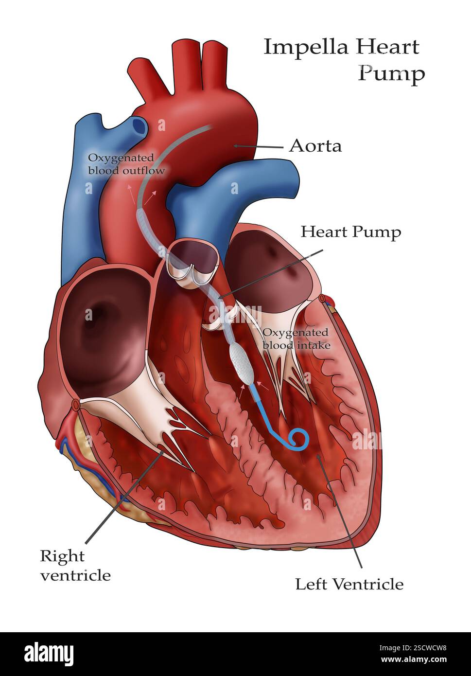 Un'illustrazione che raffigura il posizionamento e il posizionamento della pompa cardiaca Impella, un dispositivo medico utilizzato a breve termine per aiutare il cuore a pompare sangue ricco di ossigeno dal ventricolo sinistro nell'aorta. Foto Stock