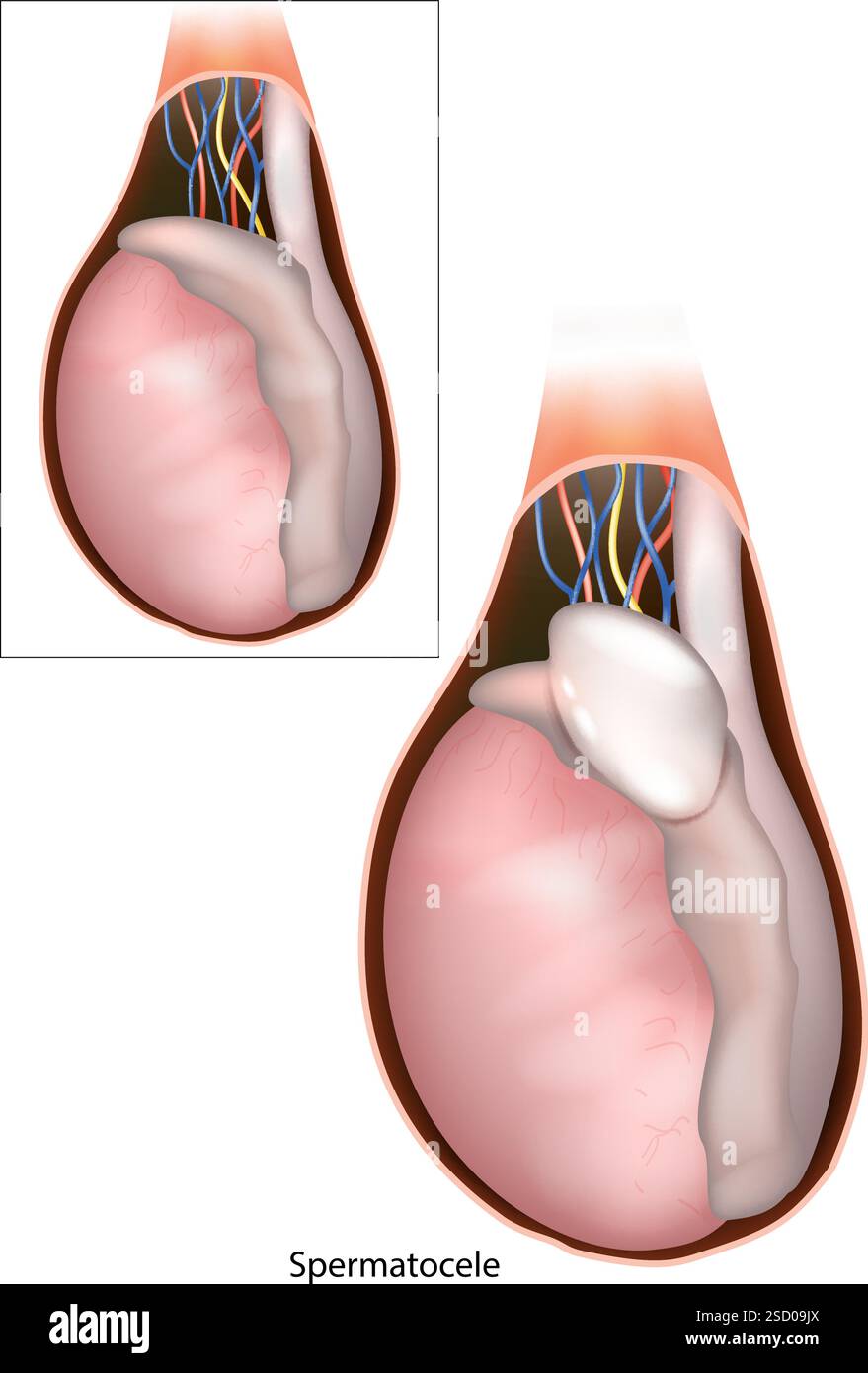 Illustrazione medica dello spermatocele. Anatomia testicolare. Disturbo del sistema riproduttivo maschile Illustrazione Vettoriale