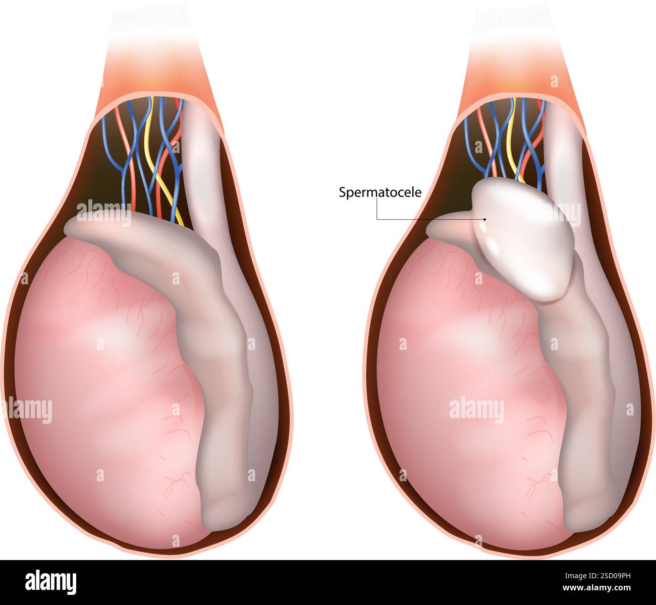 Illustrazione medica dello spermatocele. Anatomia testicolare. Disturbo del sistema riproduttivo maschile Illustrazione Vettoriale