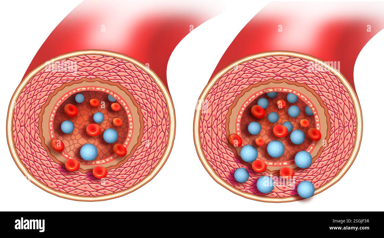 Pattern arterioso in cui uno mostra un'abbondanza di acido lattico, causando affaticamento muscolare, dolore e crampi, l'altro è normale. Foto Stock