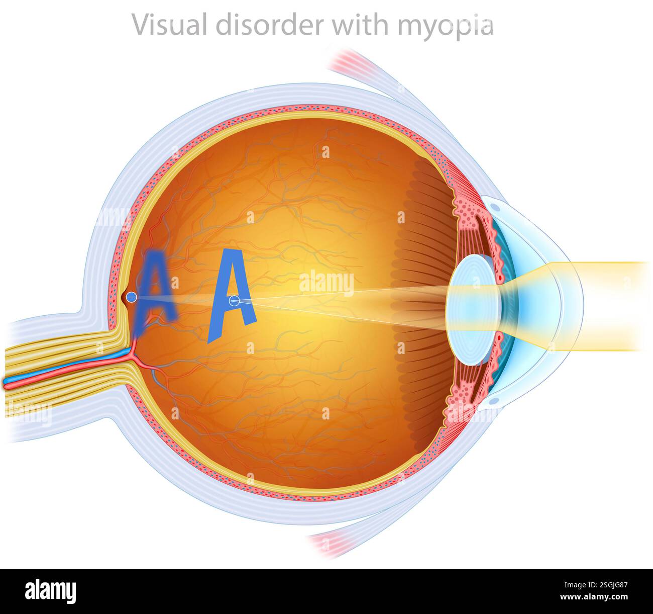 Rappresentazione della messa a fuoco visiva con miopia, questo rende difficile vedere chiaramente gli oggetti distanti, poiché l'immagine si forma prima della retina. Foto Stock