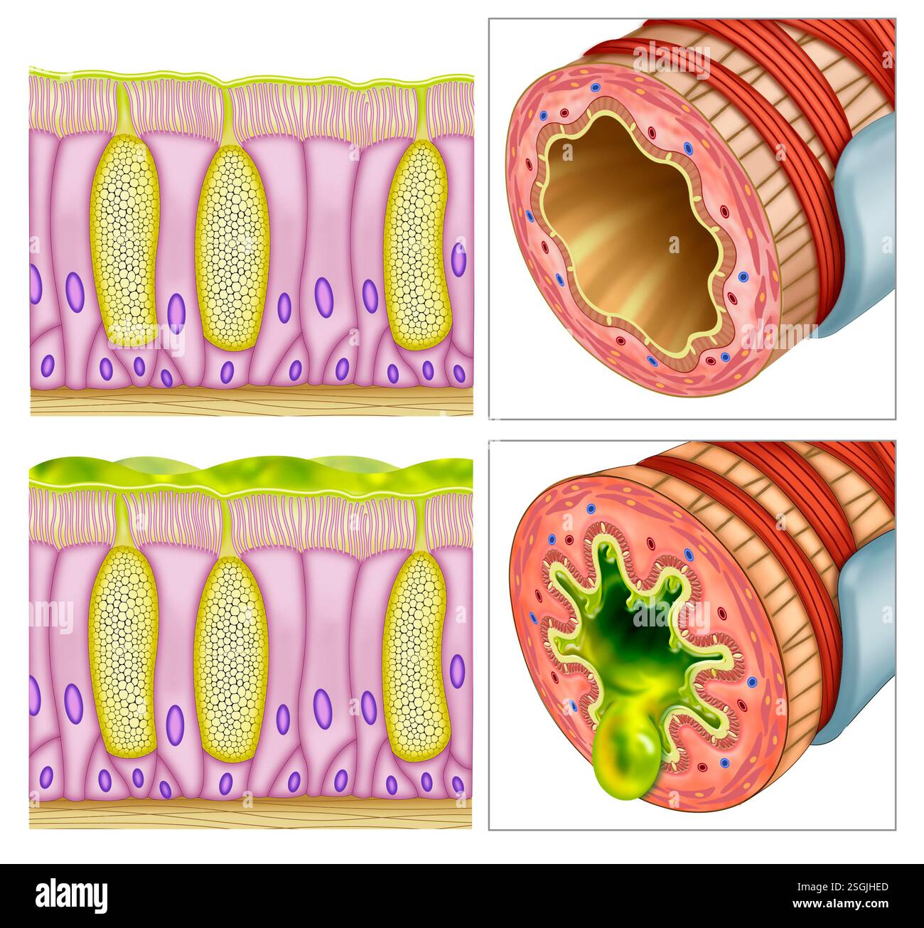Diagramma di due segmenti bronchiali. Uno con bronchite acuta, infiammazione dei bronchi, causata da virus, e l'altro sano. Foto Stock