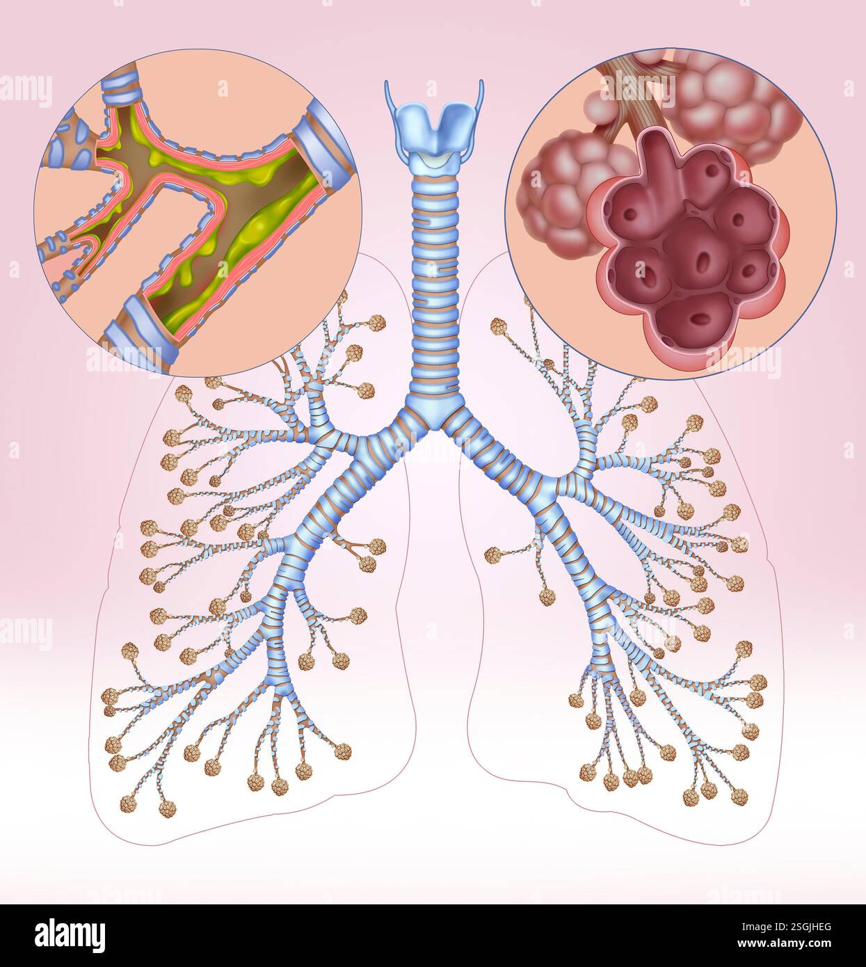 La rappresentazione della ramificazione bronchiale con bronchite è causata da virus, enfisema e pareti interne danneggiate di alveoli. Foto Stock