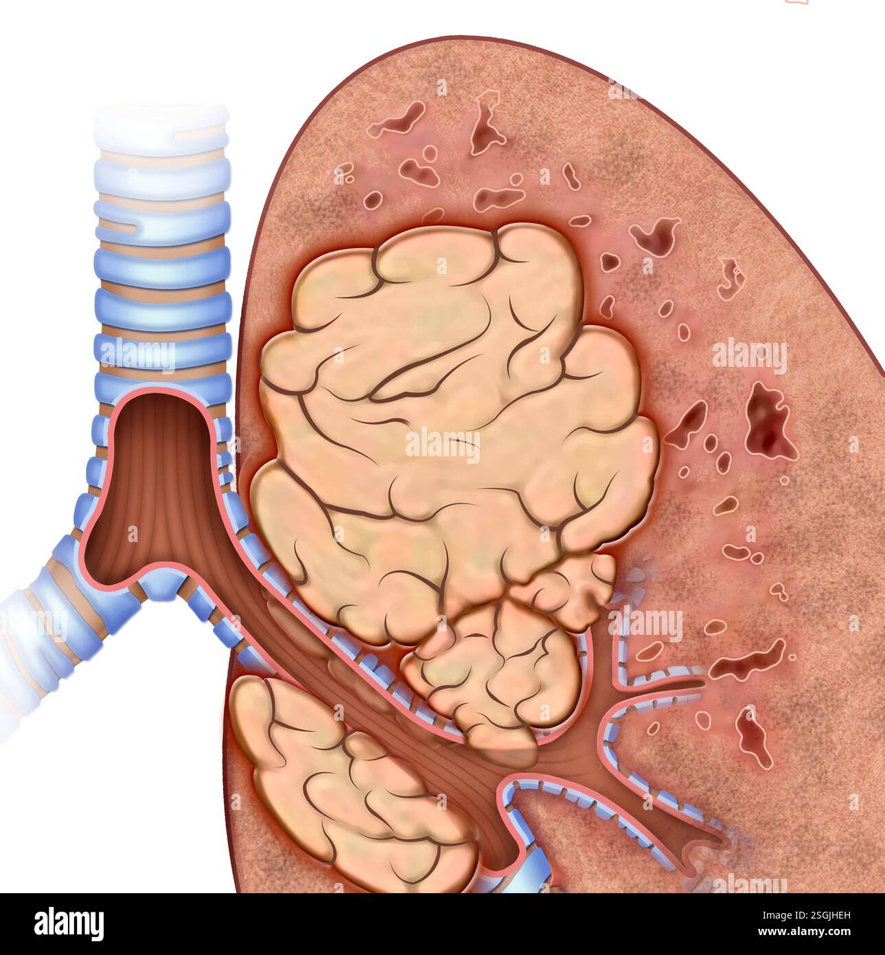Illustrazione schematica di una parte del polmone affetta da cancro polmonare in uno stadio avanzato. Foto Stock
