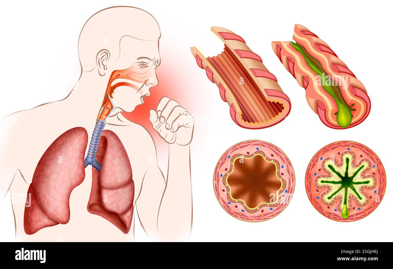 Composizione di una persona tosse e bronchi infiammati a causa di asma, una malattia cronica che provoca infiammazione e restringimento dei bronchi. Foto Stock