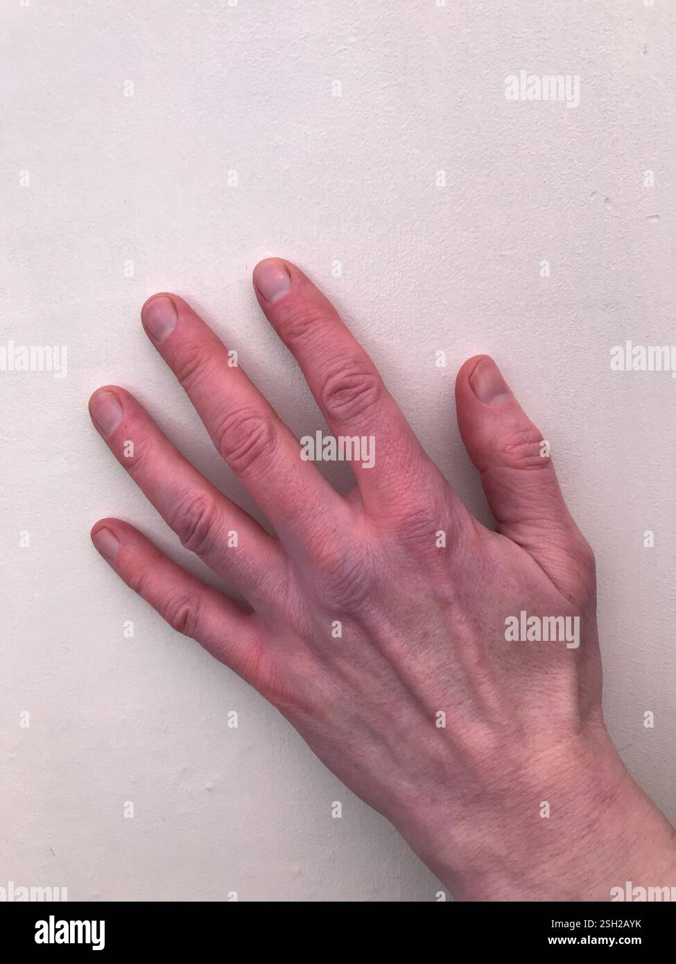 Sindrome di Raynaud, nota anche come fenomeno di Raynaud, mano bianca colloquialmente viola una parte interessata diventa bianca, poi blu, poi rosso, bruciante Foto Stock