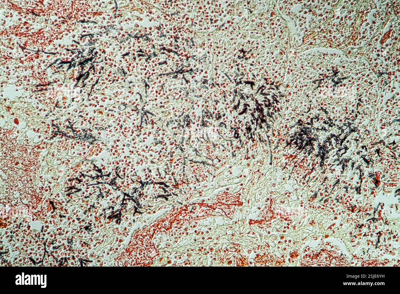 Tessuto polmonare con infezione fungina in AIDS 200x Foto Stock