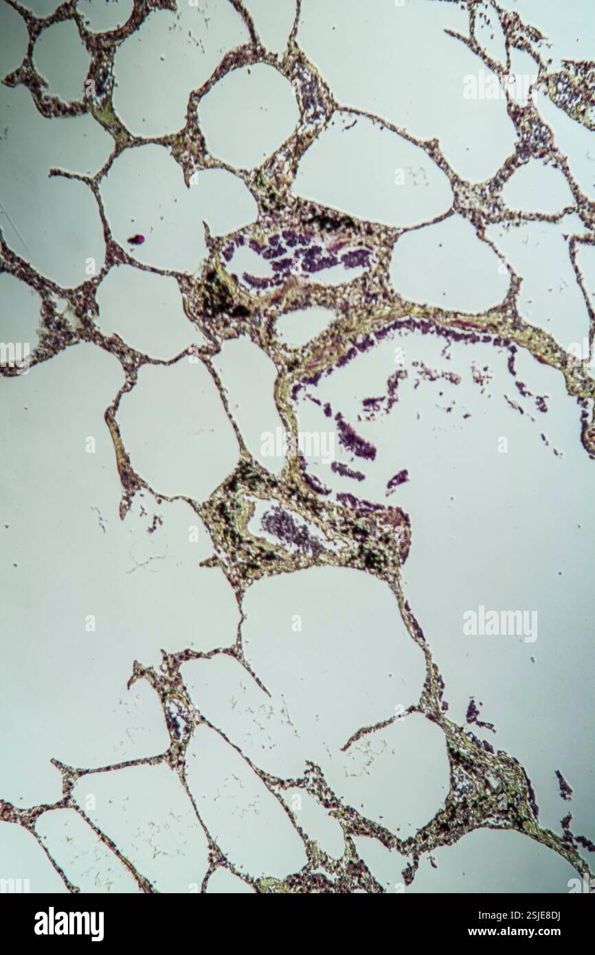 Tessuto polmonare con asma al microscopio Foto Stock