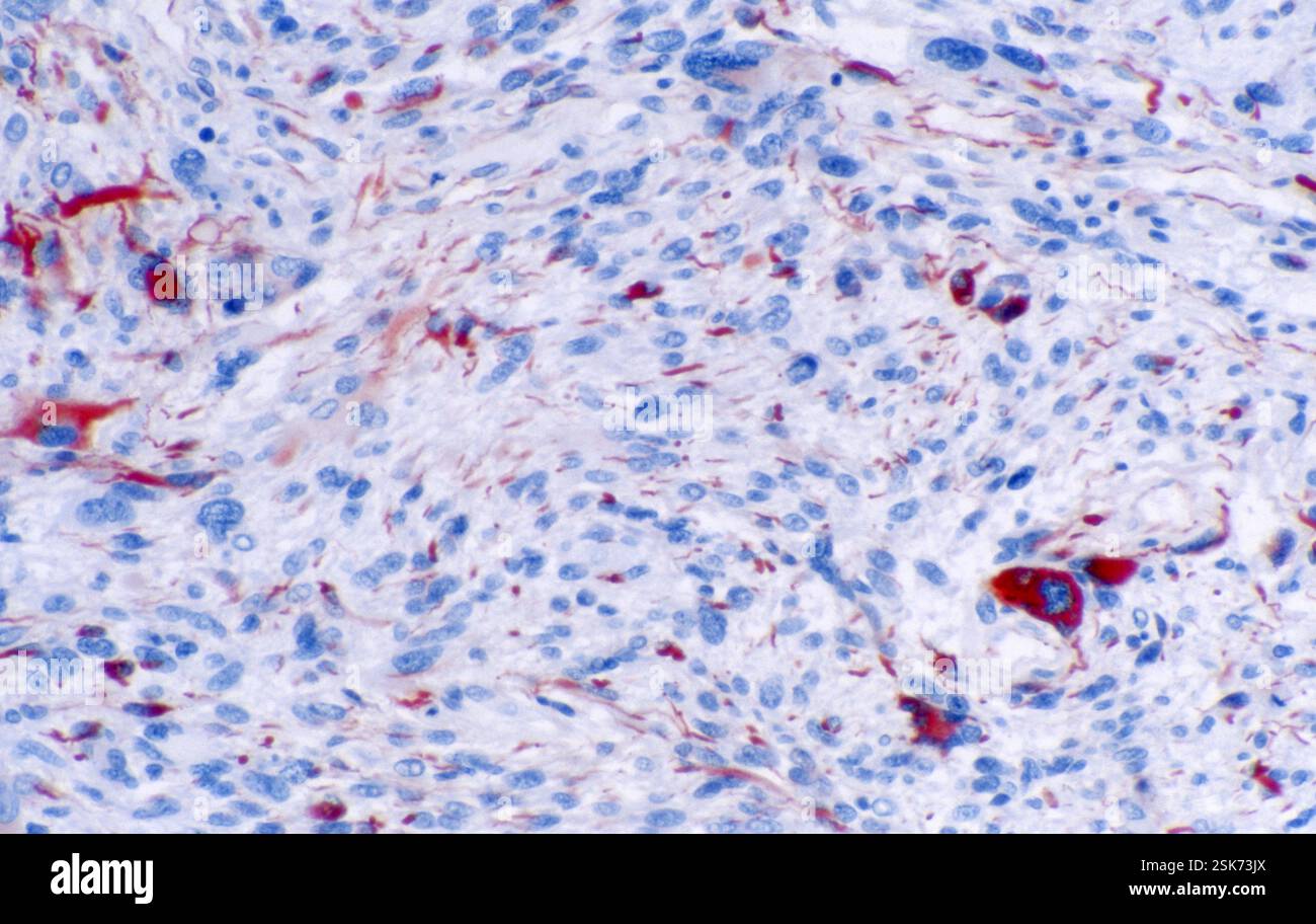 Diverticulosi intestinale, radiografia Foto Stock