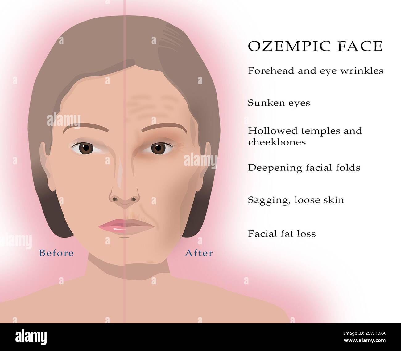 I pazienti che assumono Ozempic spesso sviluppano quello che viene comunemente chiamato "viso Ozempic". Questa condizione si verifica anche con altri farmaci per la perdita di peso, come Wegovy (semaglutide), Mounjaro (tripeptide), e liraglutide (Saxenda). Può includere rughe della fronte e degli occhi, occhi affondati, templi scavati e zigomi, pieghe facciali più profonde, pelle rilassata e sciolta. Foto Stock